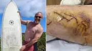 Kangaroo Island Shark Attack Survivor Shows Off Massive 27cm Bite Mark in Miraculous Recovery