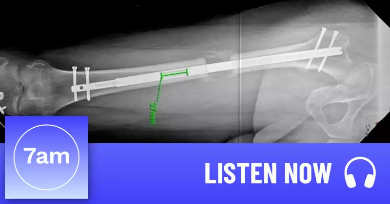 Limb Lengthening Surgery: The Risky Rise of Cosmetic Height Procedures in Australia