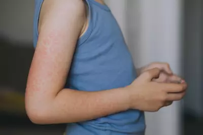 Measles Alert for Bali Flight: Urgent Warning for Perth Passengers