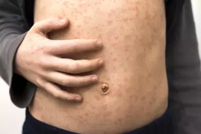 Measles Alert in Perth: Dome Cafe Among Exposure Sites After Bali Traveller Returns