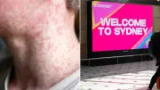 Measles Alert in Sydney: New Case Sparks Urgent Travel Warning