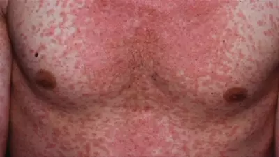 Measles cases surge in Australia, health authorities warn of undetected spread