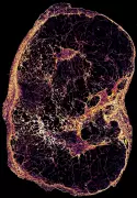 Slow-growing breast cancer cells cause late relapses, study finds