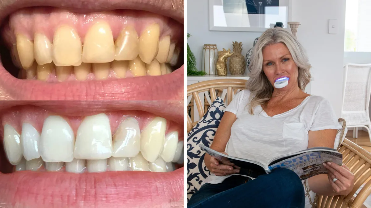 SmilePro Whitening Kit Now Half Price at Chemist Warehouse