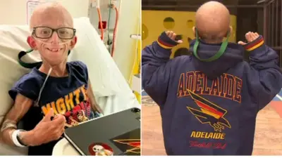 Teen with progeria hospitalised by cold urges people to stay home