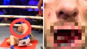 Bare Knuckle Boxer Retires After Gruesome Jaw and Teeth Injury