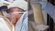 Donor Breast Milk Reduces Deadly Bowel Disease in Premature Babies by a Third